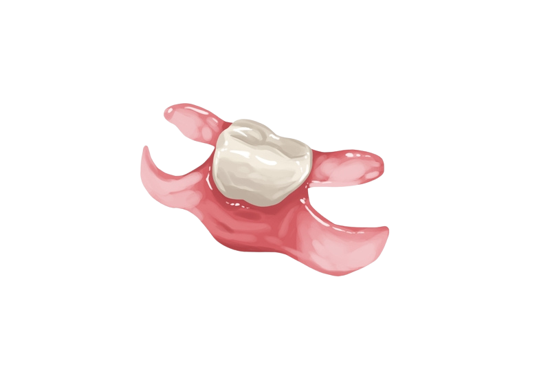 Removable Dental Bridge