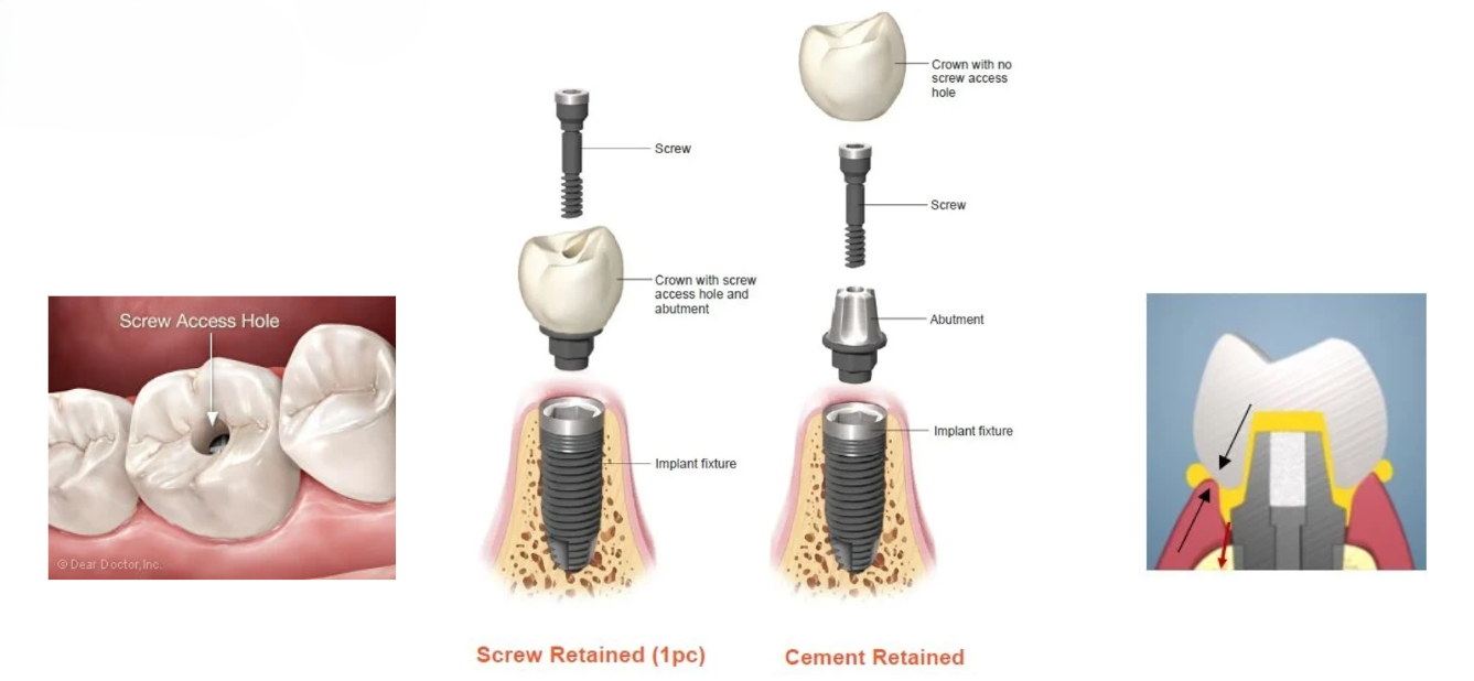 Open Sinus Lift