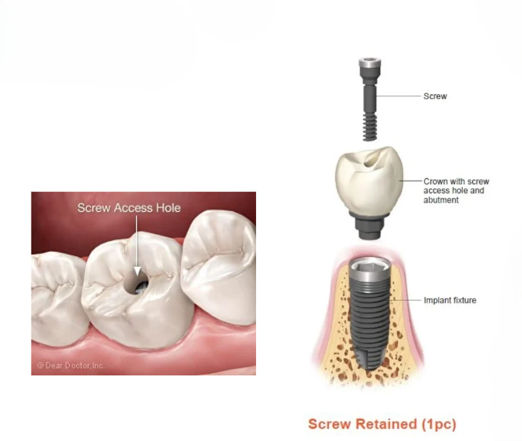 Open Sinus Lift Left