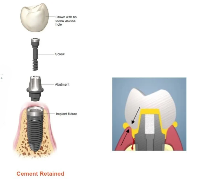 Open Sinus Lift Left