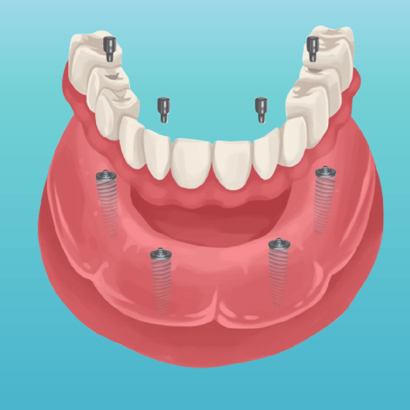 Dental Implants