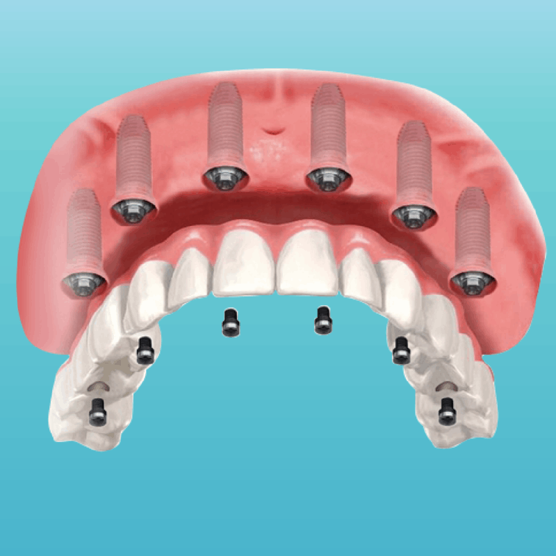 Dental Implants