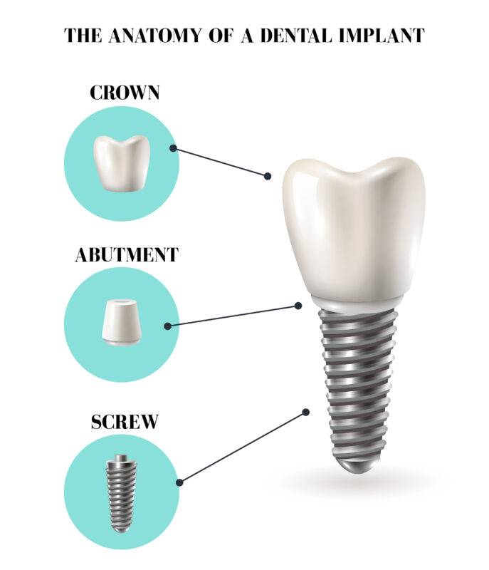 Diagram showing the anatomy of a dental implant with crown, abutment, and titanium screw - SmileBox Implant & Cosmetic Center, Bangkok