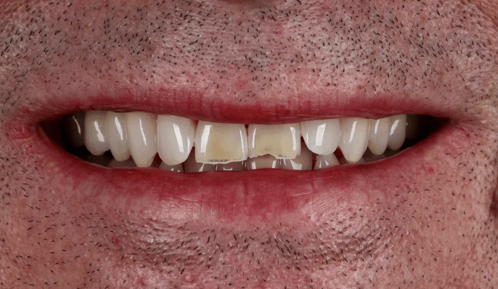 Smile transformation before and after teeth whitening treatment at SmileBox