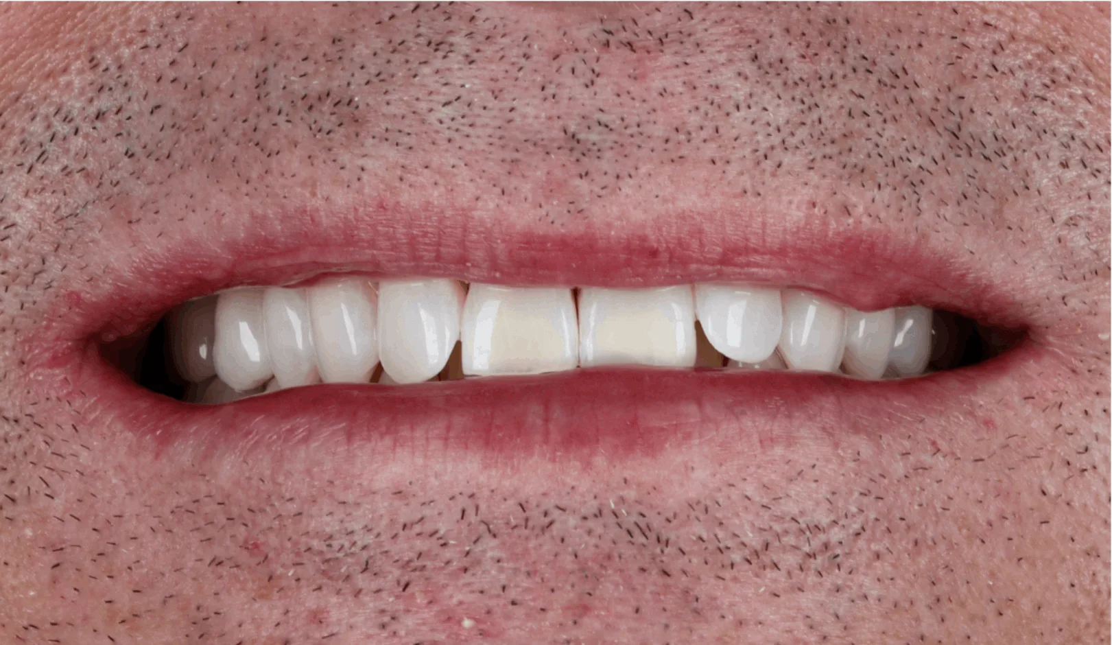 Smile transformation before and after teeth whitening treatment at SmileBox