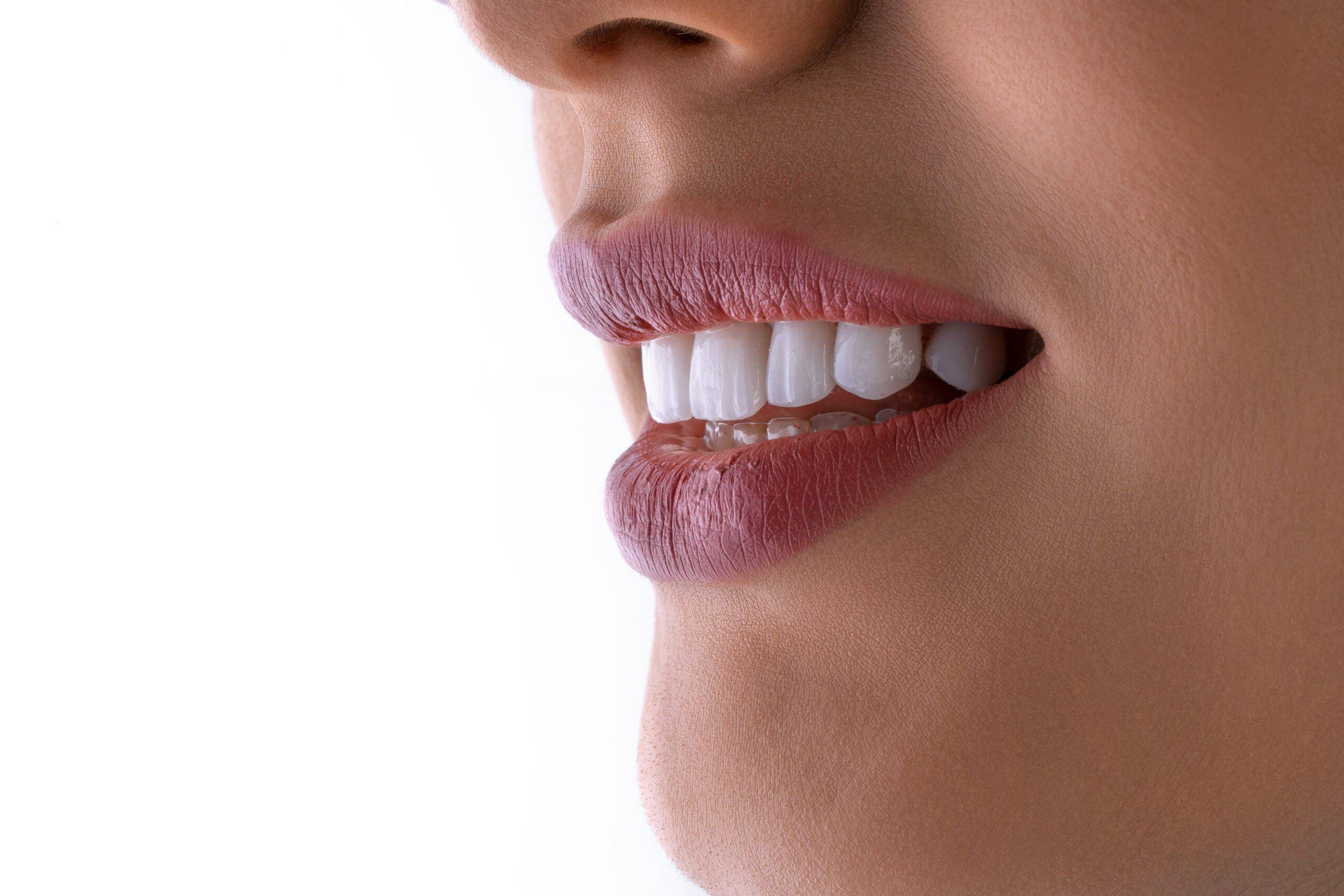 Porcelain Veneers