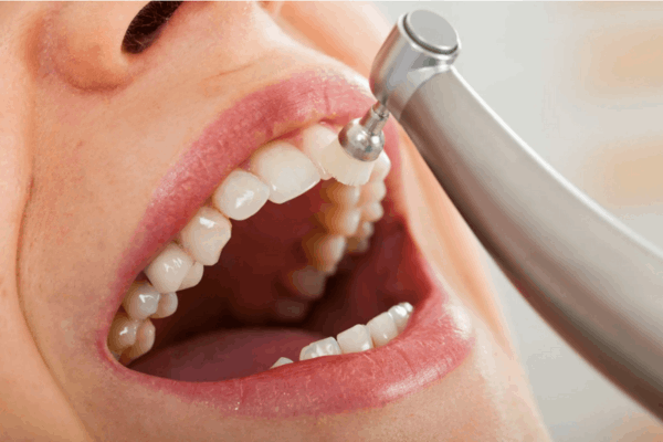 Dental Cleaning