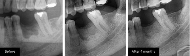 Bone graft 1