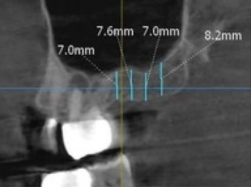 Closed Sinus Lift