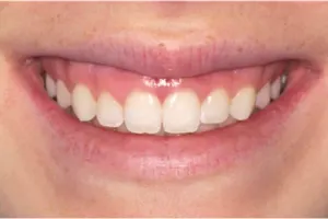 Square-shaped teeth
