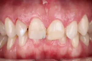 Small teeth or peg-shaped teeth