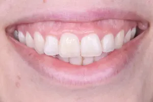 A gummy smile