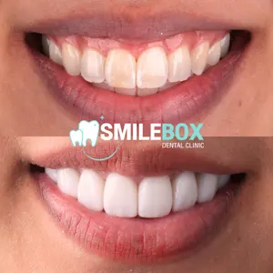 Ceramic veneer