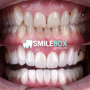 Ceramic veneer