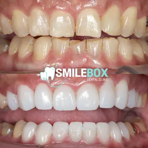 Ceramic veneer