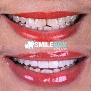 Ceramic veneer
