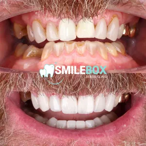 Ceramic veneer