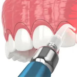 Gingivectomy / Esthetic Crown Lengthening