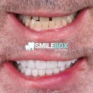 Ceramic veneer