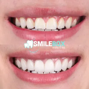 Composite veneer