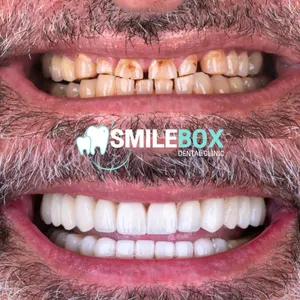 Ceramic veneer