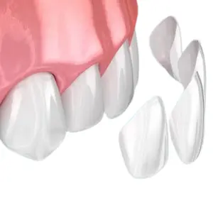 Ceramic Veneers
