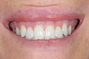 Uneven gum lines
