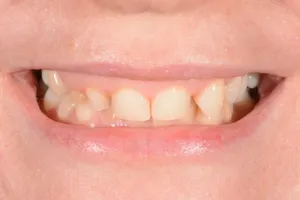 Short teeth