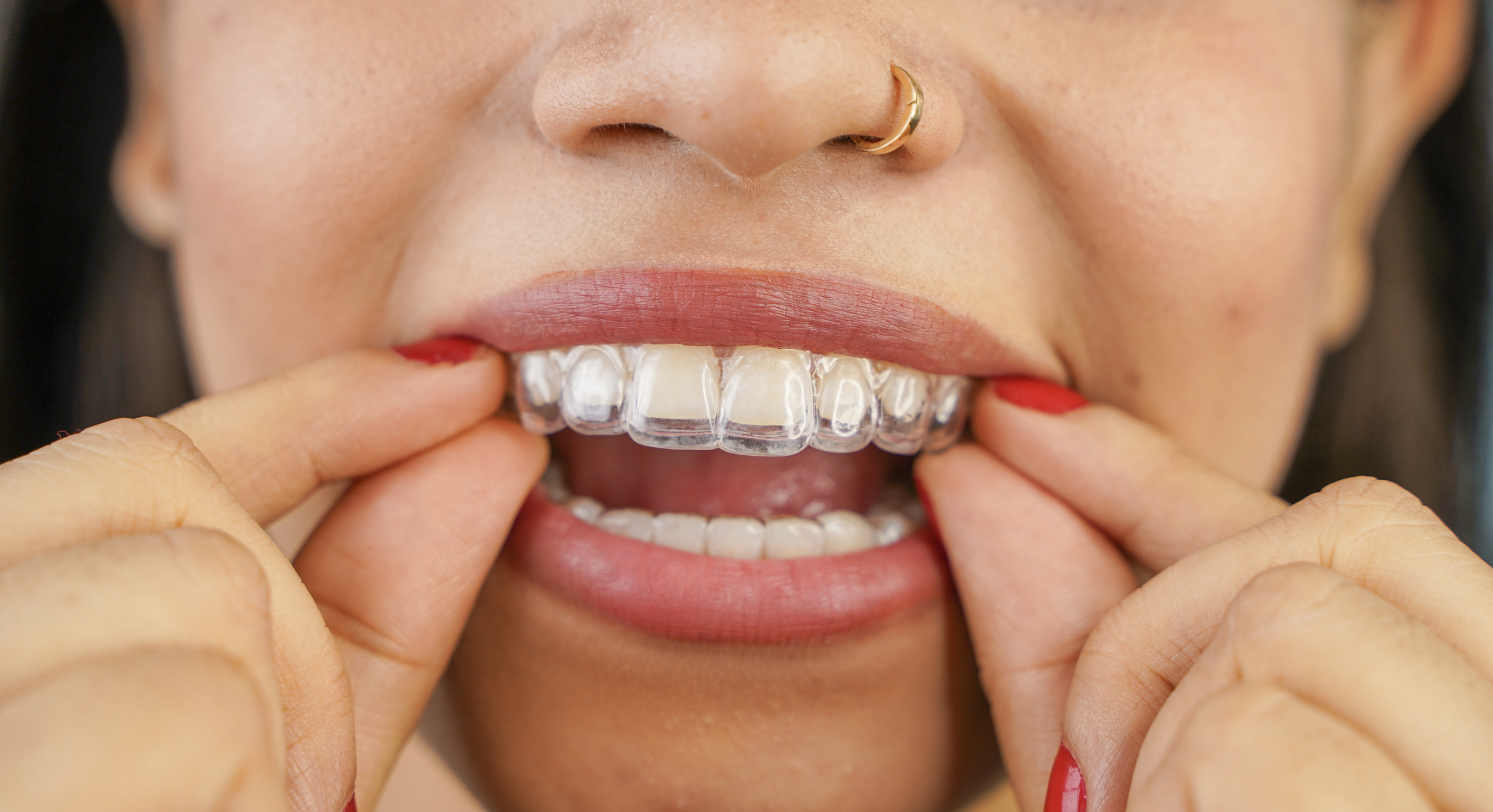 A woman wearing clear Invisalign
