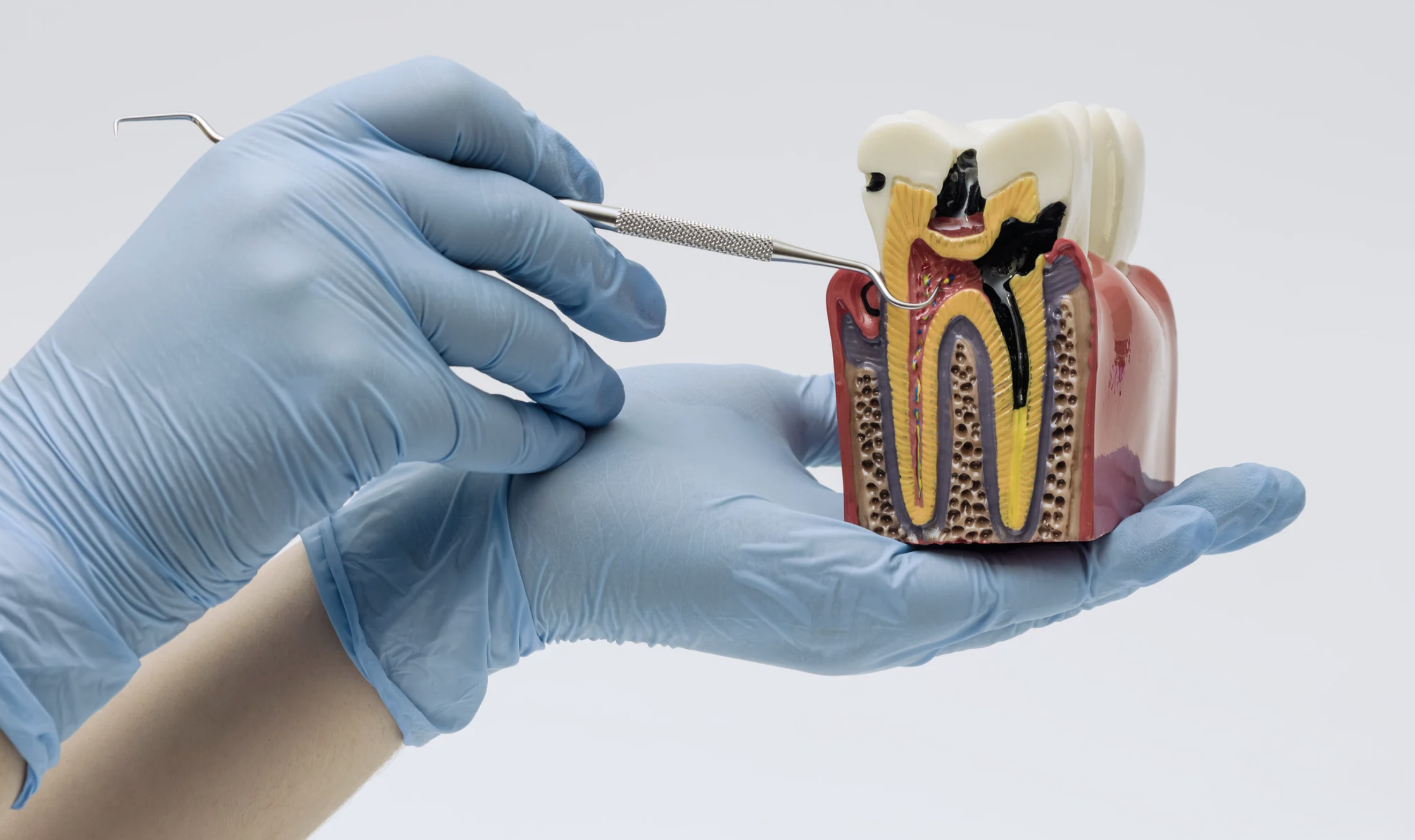 Dentist using a tooth model to explain the root canal treatment steps and pulp anatomy