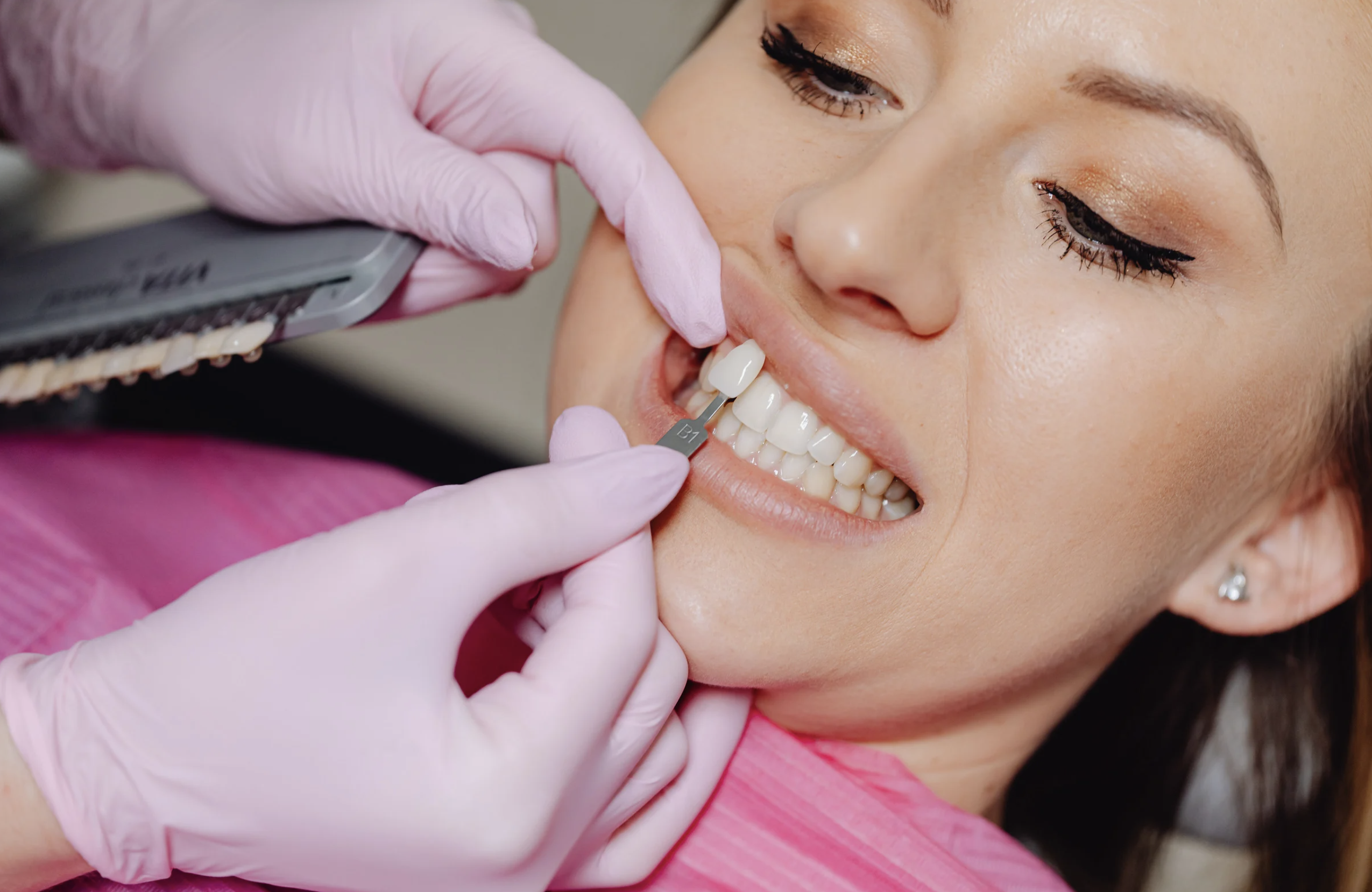 A dentist explaining what the types of veneers are to a patient