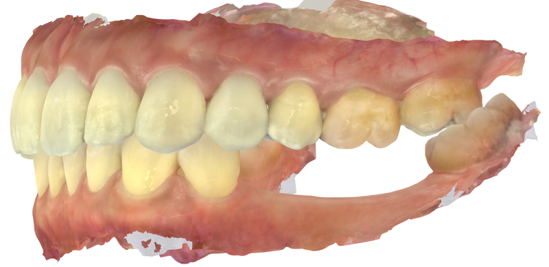 intra-oral 5D scan