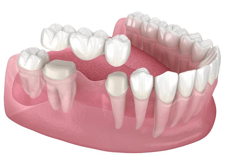 Dental Bridge