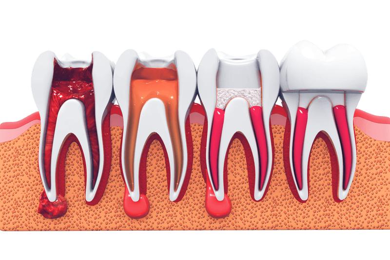 Root Canal Treatment