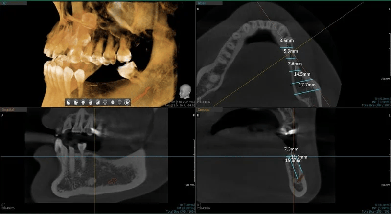 CBCT scan